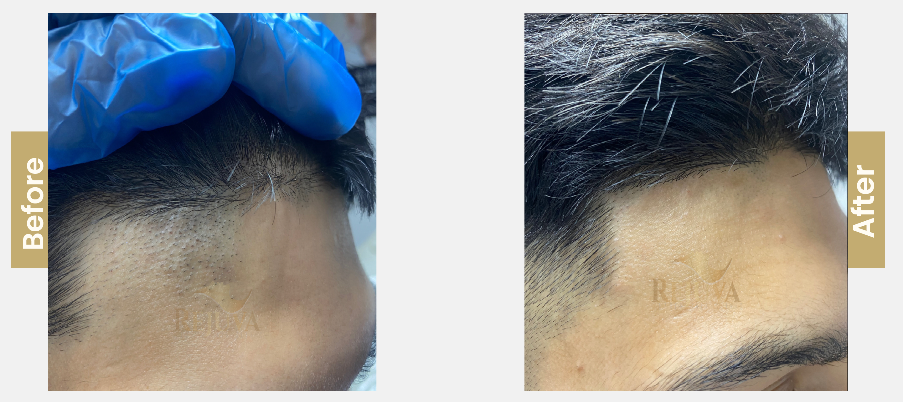 hair restoration-01