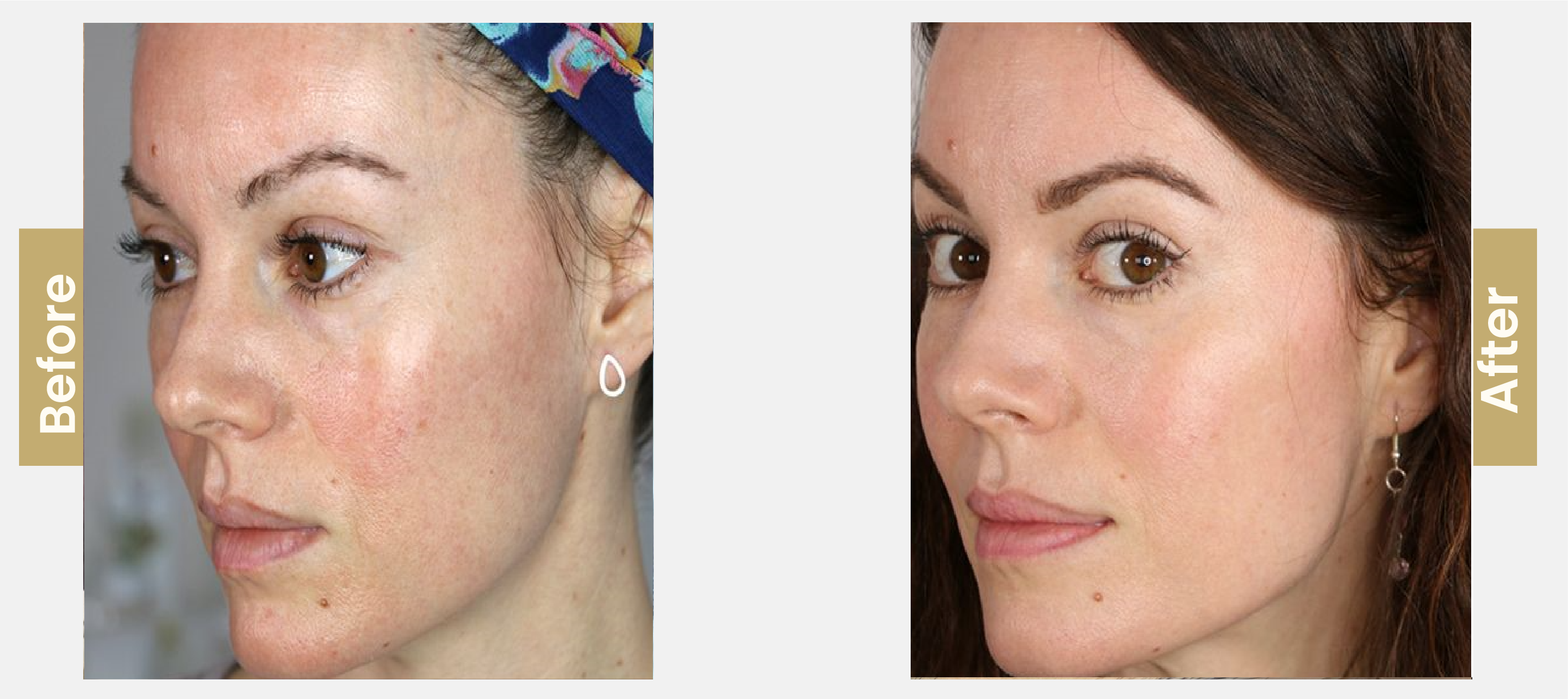 microneedling 01-01