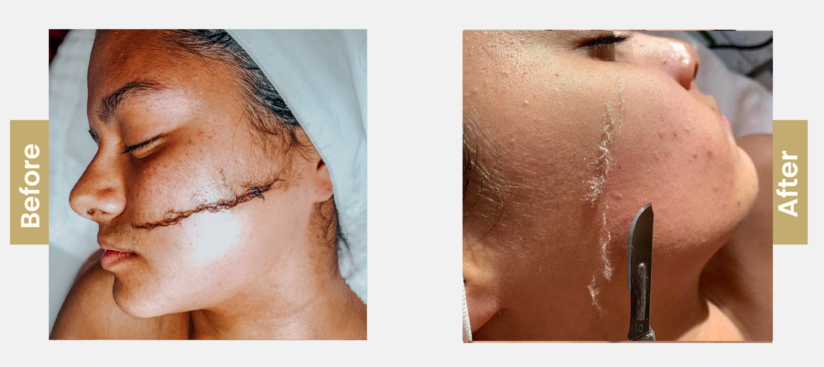 Dermaplaning-01