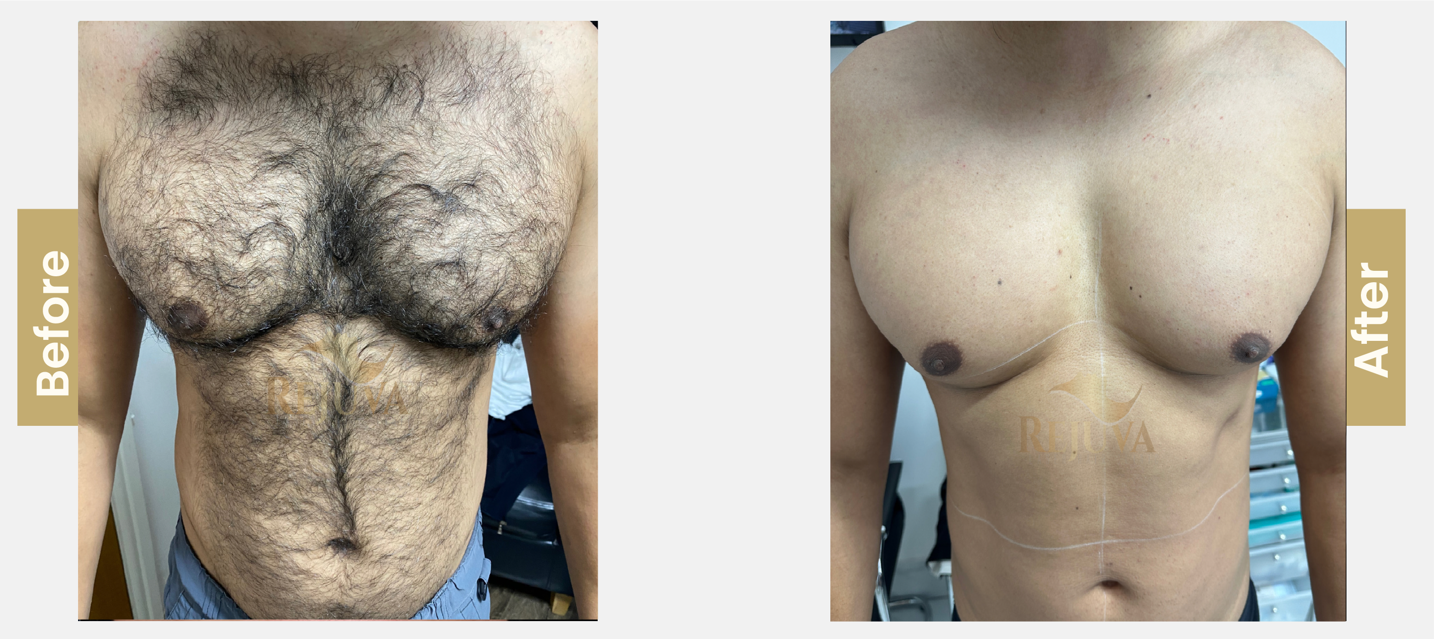 hair-removal-chest-01-01-1